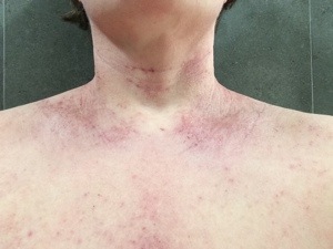 tsw-eczema-day-20-neck