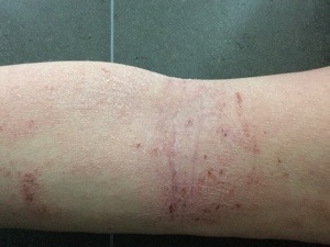 tsw-eczema-day-8-arm