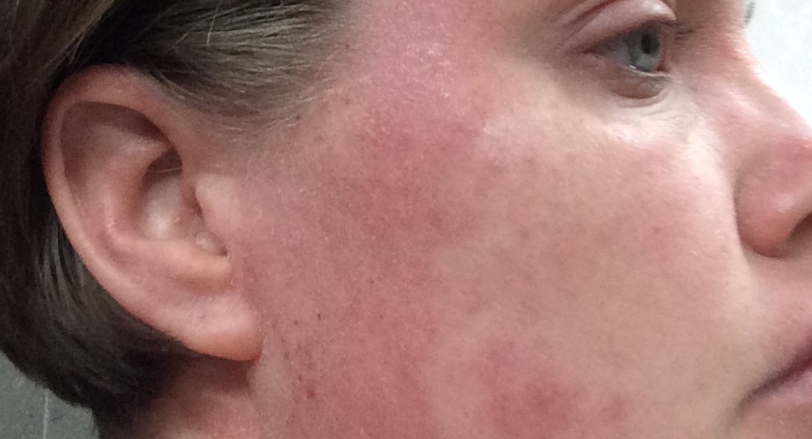 Eczema on face