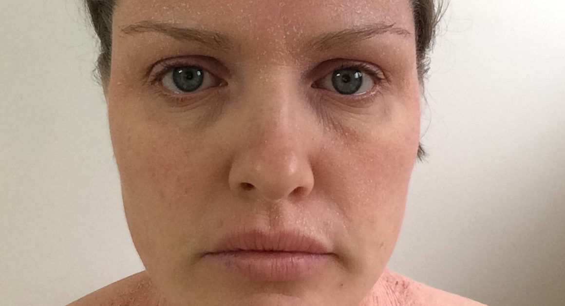 Eczema progress on face